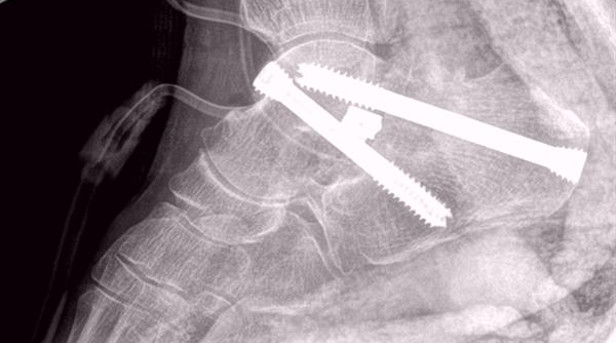 В Китае двум пациенткам успешно пересадили 3D-печатные костные имплантаты - 1